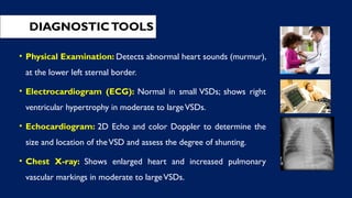 DIAGNOSTICTOOLS
• Physical Examination: Detects abnormal heart sounds (murmur),
at the lower left sternal border.
• Electrocardiogram (ECG): Normal in small VSDs; shows right
ventricular hypertrophy in moderate to largeVSDs.
• Echocardiogram: 2D Echo and color Doppler to determine the
size and location of theVSD and assess the degree of shunting.
• Chest X-ray: Shows enlarged heart and increased pulmonary
vascular markings in moderate to largeVSDs.
 