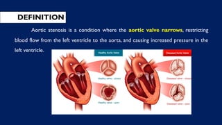 DEFINITION
Aortic stenosis is a condition where the aortic valve narrows, restricting
blood flow from the left ventricle to the aorta, and causing increased pressure in the
left ventricle.
 