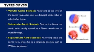 TYPES OFVSD
• Valvular Aortic Stenosis: Narrowing at the level of
the aortic valve, often due to a bicuspid aortic valve or
valve leaflet fusion.
• Subvalvular Aortic Stenosis: Obstruction below the
aortic valve, usually caused by a fibrous membrane or
muscular ridge.
• Supravalvular Aortic Stenosis: Narrowing above the
aortic valve, often due to a congenital anomaly such as
Williams syndrome.
 