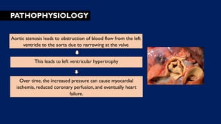 PATHOPHYSIOLOGY
Aortic stenosis leads to obstruction of blood flow from the left
ventricle to the aorta due to narrowing at the valve
This leads to left ventricular hypertrophy
Over time, the increased pressure can cause myocardial
ischemia, reduced coronary perfusion, and eventually heart
failure.
 