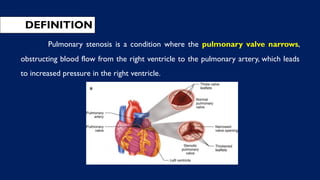 DEFINITION
Pulmonary stenosis is a condition where the pulmonary valve narrows,
obstructing blood flow from the right ventricle to the pulmonary artery, which leads
to increased pressure in the right ventricle.
 