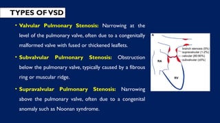 TYPES OFVSD
• Valvular Pulmonary Stenosis: Narrowing at the
level of the pulmonary valve, often due to a congenitally
malformed valve with fused or thickened leaflets.
• Subvalvular Pulmonary Stenosis: Obstruction
below the pulmonary valve, typically caused by a fibrous
ring or muscular ridge.
• Supravalvular Pulmonary Stenosis: Narrowing
above the pulmonary valve, often due to a congenital
anomaly such as Noonan syndrome.
 