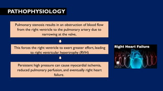 PATHOPHYSIOLOGY
Pulmonary stenosis results in an obstruction of blood flow
from the right ventricle to the pulmonary artery due to
narrowing at the valve,
This forces the right ventricle to exert greater effort, leading
to right ventricular hypertrophy (RVH)
Persistent high pressure can cause myocardial ischemia,
reduced pulmonary perfusion, and eventually right heart
failure.
 