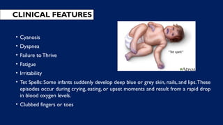 CLINICAL FEATURES
• Cyanosis
• Dyspnea
• Failure to Thrive
• Fatigue
• Irritability
• Tet Spells: Some infants suddenly develop deep blue or grey skin, nails, and lips.These
episodes occur during crying, eating, or upset moments and result from a rapid drop
in blood oxygen levels.
• Clubbed fingers or toes
 