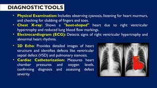 DIAGNOSTICTOOLS
• 2D Echo: Provides detailed images of heart
structure and identifies defects like ventricular
septal defect (VSD) and pulmonary stenosis.
• Cardiac Catheterization: Measures heart
chamber pressures and oxygen levels,
confirming diagnosis and assessing defect
severity.
• Physical Examination: Includes observing cyanosis, listening for heart murmurs,
and checking for clubbing of fingers and toes.
• Chest X-ray: Shows a "boot-shaped" heart due to right ventricular
hypertrophy and reduced lung blood flow markings.
• Electrocardiogram (ECG): Detects signs of right ventricular hypertrophy and
abnormal heart rhythms.
 