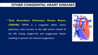 OTHER CONGENITAL HEART DISEASES
• Total Anomalous Pulmonary Venous Return
(TAPVR): TAPVR is a congenital defect where
pulmonary veins connect to the right atrium instead of
the left, mixing oxygen-rich and oxygen-poor blood,
resulting in cyanosis and reduced oxygenation.
 