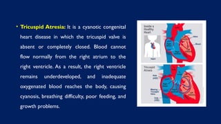 • Tricuspid Atresia: It is a cyanotic congenital
heart disease in which the tricuspid valve is
absent or completely closed. Blood cannot
flow normally from the right atrium to the
right ventricle. As a result, the right ventricle
remains underdeveloped, and inadequate
oxygenated blood reaches the body, causing
cyanosis, breathing difficulty, poor feeding, and
growth problems.
 