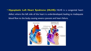 • Hypoplastic Left Heart Syndrome (HLHS): HLHS is a congenital heart
defect where the left side of the heart is underdeveloped, leading to inadequate
blood flow to the body, causing severe cyanosis and heart failure.
 