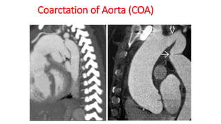 Coarctation of Aorta (COA)
 