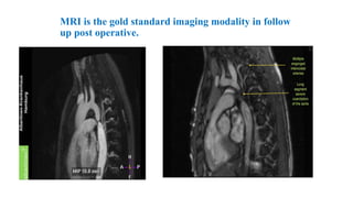 MRI is the gold standard imaging modality in follow
up post operative.
 