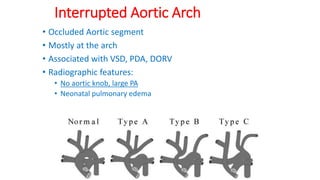 • Occluded Aortic segment
• Mostly at the arch
• Associated with VSD, PDA, DORV
• Radiographic features:
• No aortic knob, large PA
• Neonatal pulmonary edema
Interrupted Aortic Arch
 