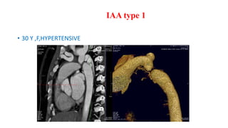 IAA type 1
• 30 Y ,F,HYPERTENSIVE
 