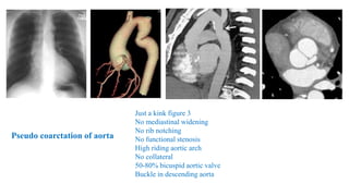 Just a kink figure 3
No mediastinal widening
No rib notching
No functional stenosis
High riding aortic arch
No collateral
50-80% bicuspid aortic valve
Buckle in descending aorta
Pseudo coarctation of aorta
 