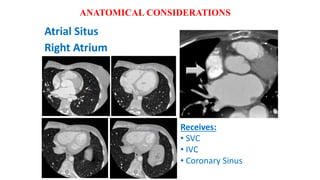 Atrial Situs
Right Atrium
Receives:
• SVC
• IVC
• Coronary Sinus
ANATOMICAL CONSIDERATIONS
 