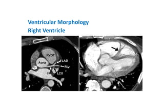 Ventricular Morphology
Right Ventricle
 