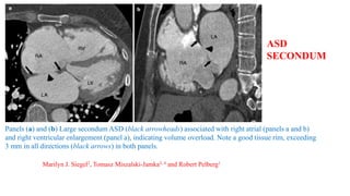 Panels (a) and (b) Large secondum ASD (black arrowheads) associated with right atrial (panels a and b)
and right ventricular enlargement (panel a), indicating volume overload. Note a good tissue rim, exceeding
3 mm in all directions (black arrows) in both panels.
Marilyn J. Siegel2, Tomasz Miszalski-Jamka3, 4 and Robert Pelberg1
ASD
SECONDUM
 