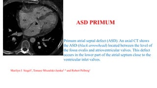 Primum atrial septal defect (ASD). An axial CT shows
the ASD (black arrowhead) located between the level of
the fossa ovalis and atrioventricular valves. This defect
occurs in the lower part of the atrial septum close to the
ventricular inlet valves.
ASD PRIMUM
Marilyn J. Siegel2, Tomasz Miszalski-Jamka3, 4 and Robert Pelberg1
 