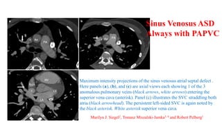 Maximum intensity projections of the sinus venosus atrial septal defect .
Here panels (a), (b), and (c) are axial views each showing 1 of the 3
anomalous pulmonary veins (black arrows, white arrows) entering the
superior vena cava (asterisk). Panel (c) illustrates the SVC straddling both
atria (black arrowhead). The persistent left-sided SVC is again noted by
the black asterisk. White asterisk superior vena cava.
Sinus Venosus ASD
Always with PAPVC
Marilyn J. Siegel2, Tomasz Miszalski-Jamka3, 4 and Robert Pelberg1
 