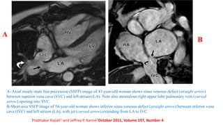 A- Axial steady-state free precession (SSFP) image of 43-year-old woman shows sinus venosus defect (straight arrow)
between superior vena cava (SVC) and left atrium (LA). Note also anomalous right upper lobe pulmonary vein (curved
arrow) opening into SVC.
B-Short-axis SSFP image of 54-year-old woman shows inferior sinus venosus defect (straight arrow) between inferior vena
cava (IVC) and left atrium (LA), with jet (curved arrow) extending from LA to IVC.
A
B
Prabhakar Rajiah1 and Jeffrey P. Kanne2October 2011, Volume 197, Number 4
 