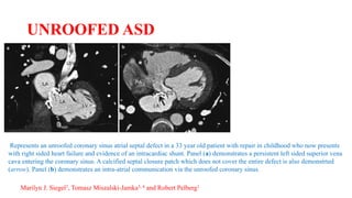 UNROOFED ASD
Represents an unroofed coronary sinus atrial septal defect in a 33 year old patient with repair in childhood who now presents
with right sided heart failure and evidence of an intracardiac shunt. Panel (a) demonstrates a persistent left sided superior vena
cava entering the coronary sinus. A calcified septal closure patch which does not cover the entire defect is also demonstrted
(arrow). Panel (b) demonstrates an intra-atrial communication via the unroofed coronary sinus.
Marilyn J. Siegel2, Tomasz Miszalski-Jamka3, 4 and Robert Pelberg1
 