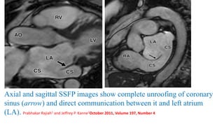 Axial and sagittal SSFP images show complete unroofing of coronary
sinus (arrow) and direct communication between it and left atrium
(LA). Prabhakar Rajiah1 and Jeffrey P. Kanne2October 2011, Volume 197, Number 4
 