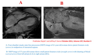 A- Four-chamber steady-state free precession (SSFP) image of 61-year-old woman shows patent foramen ovale
(arrow) in midportion of interatrial septum.
B- SSFP image of 37-year-old woman shows small patent foramen ovale (straight arrow) with shunting of blood
(curved arrow) from left atrium (LA) to right atrium (RA).
A B
Prabhakar Rajiah1 and Jeffrey P. Kanne2October 2011, Volume 197, Number 4
 