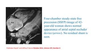Four-chamber steady-state free
precession (SSFP) image of 42-
year-old woman shows normal
appearance of atrial septal occluder
device (arrow). No residual shunt is
seen.
Prabhakar Rajiah1 and Jeffrey P. Kanne2October 2011, Volume 197, Number 4
 
