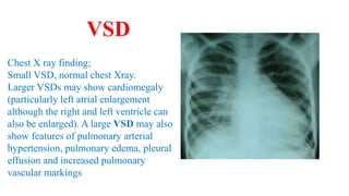 Chest X ray finding;
Small VSD, normal chest Xray.
Larger VSDs may show cardiomegaly
(particularly left atrial enlargement
although the right and left ventricle can
also be enlarged). A large VSD may also
show features of pulmonary arterial
hypertension, pulmonary edema, pleural
effusion and increased pulmonary
vascular markings
VSD
 