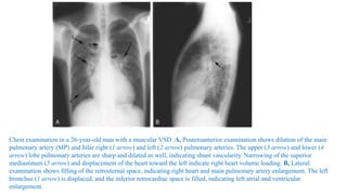 Chest examination in a 26-year-old man with a muscular VSD. A, Posteroanterior examination shows dilation of the main
pulmonary artery (MP) and hilar right (1 arrow) and left (2 arrow) pulmonary arteries. The upper (3 arrow) and lower (4
arrow) lobe pulmonary arteries are sharp and dilated as well, indicating shunt vascularity. Narrowing of the superior
mediastinum (5 arrow) and displacement of the heart toward the left indicate right heart volume loading. B, Lateral
examination shows filling of the retrosternal space, indicating right heart and main pulmonary artery enlargement. The left
bronchus (1 arrow) is displaced, and the inferior retrocardiac space is filled, indicating left atrial and ventricular
enlargement.
 