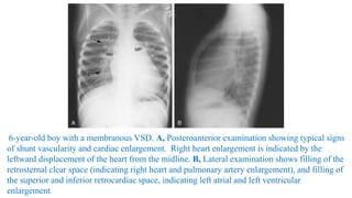 6-year-old boy with a membranous VSD. A, Posteroanterior examination showing typical signs
of shunt vascularity and cardiac enlargement. Right heart enlargement is indicated by the
leftward displacement of the heart from the midline. B, Lateral examination shows filling of the
retrosternal clear space (indicating right heart and pulmonary artery enlargement), and filling of
the superior and inferior retrocardiac space, indicating left atrial and left ventricular
enlargement.
 