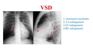 VSD
1- increased vascularity
2- LA enlargement
3-LV enlargement
4-RV enlargement1 2
3
4
 