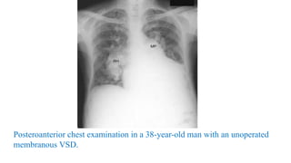 Posteroanterior chest examination in a 38-year-old man with an unoperated
membranous VSD.
 