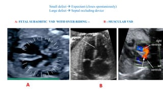 Small defect  Expectant (closes spontaneously)
Large defect  Septal occluding device
A- FETAL SUBAORTIC VSD WITH OVER-RIDING -- B --MUSCULAR VSD
A B
 