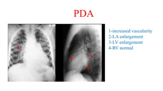 PDA
1
1-increased vascularity
2-LA enlargement
3-LV enlargement
4-RV normal
4
3
2
 