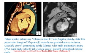 Patent ductus arteriosus. Volume render CT and Sagittal steady-state free
precession image of 32-year-old man shows patent ductus arteriosus
(straight arrow) connecting aortic isthmus with main pulmonary artery
(PA), with high-velocity jet (curved arrow) present throughout cardiac
Prabhakar Rajiah1 and Jeffrey P. Kanne2October 2011, Volume 197, Number 4
 