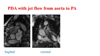 PDA with jet flow from aorta to PA
Sagittal coronal
 