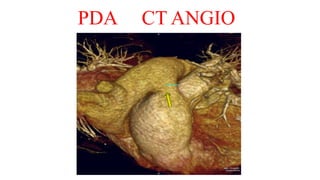 PDA CT ANGIO
 