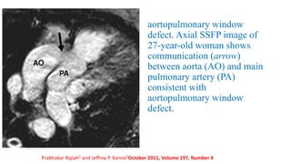 aortopulmonary window
defect. Axial SSFP image of
27-year-old woman shows
communication (arrow)
between aorta (AO) and main
pulmonary artery (PA)
consistent with
aortopulmonary window
defect.
Prabhakar Rajiah1 and Jeffrey P. Kanne2October 2011, Volume 197, Number 4
 