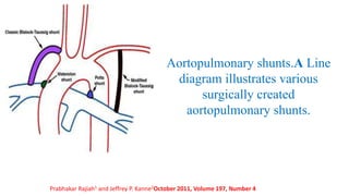Aortopulmonary shunts.A Line
diagram illustrates various
surgically created
aortopulmonary shunts.
Prabhakar Rajiah1 and Jeffrey P. Kanne2October 2011, Volume 197, Number 4
 