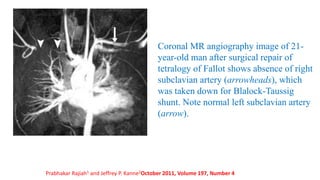 Coronal MR angiography image of 21-
year-old man after surgical repair of
tetralogy of Fallot shows absence of right
subclavian artery (arrowheads), which
was taken down for Blalock-Taussig
shunt. Note normal left subclavian artery
(arrow).
Prabhakar Rajiah1 and Jeffrey P. Kanne2October 2011, Volume 197, Number 4
 