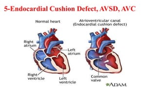 5-Endocardial Cushion Defect, AVSD, AVC
 