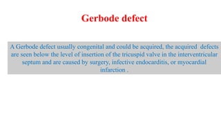 Gerbode defect
A Gerbode defect usually congenital and could be acquired, the acquired defects
are seen below the level of insertion of the tricuspid valve in the interventricular
septum and are caused by surgery, infective endocarditis, or myocardial
infarction .
 