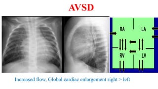 Increased flow, Global cardiac enlargement right > left
AVSD
 