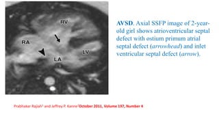 AVSD. Axial SSFP image of 2-year-
old girl shows atrioventricular septal
defect with ostium primum atrial
septal defect (arrowhead) and inlet
ventricular septal defect (arrow).
Prabhakar Rajiah1 and Jeffrey P. Kanne2October 2011, Volume 197, Number 4
 