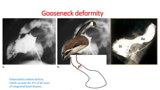 Gooseneck deformity
Endocardial cushion defects,
which account for 4% of all cases
of congenital heart disease,
 