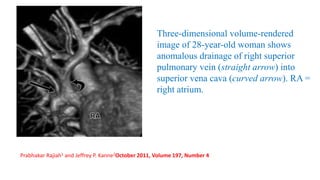 Three-dimensional volume-rendered
image of 28-year-old woman shows
anomalous drainage of right superior
pulmonary vein (straight arrow) into
superior vena cava (curved arrow). RA =
right atrium.
Prabhakar Rajiah1 and Jeffrey P. Kanne2October 2011, Volume 197, Number 4
 