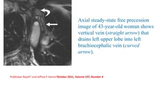 Axial steady-state free precession
image of 43-year-old woman shows
vertical vein (straight arrow) that
drains left upper lobe into left
brachiocephalic vein (curved
arrow).
Prabhakar Rajiah1 and Jeffrey P. Kanne2October 2011, Volume 197, Number 4
 