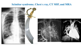 Scimitar syndrome. Chest x ray, CT MIP, and MRA
 
