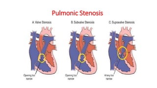 Pulmonic Stenosis
 