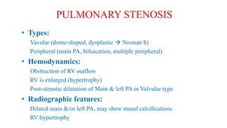 • Types:
Vavular (dome-shaped, dysplastic  Noonan $)
Peripheral (main PA, bifurcation, multiple peripheral)
• Hemodynamics:
Obstruction of RV outflow
RV is enlarged (hypertrophy)
Post-stenotic dilatation of Main & left PA in Valvular type
• Radiographic features:
Dilated main &/or left PA, may show mural calcifications
RV hypertrophy
PULMONARY STENOSIS
 